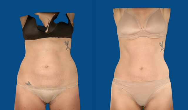 Body Contouring Wenatchee WA – Cascadian Plastic Surgery - Body Sculpting